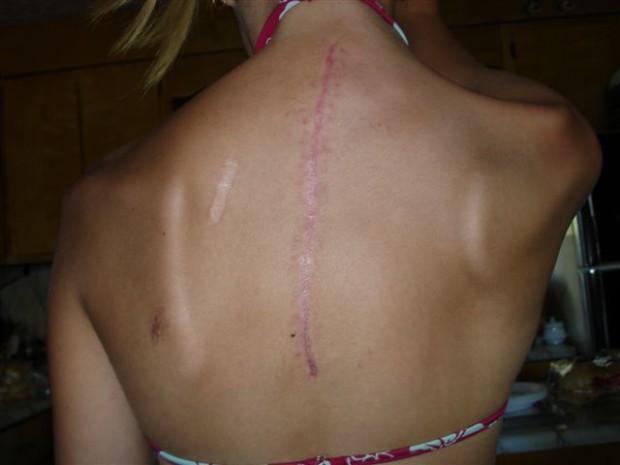 Kelsey’s scar